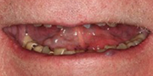 Decayed and missing teeth