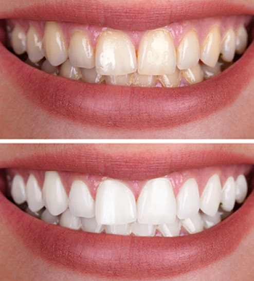 A woman’s smile before and after teeth whitening